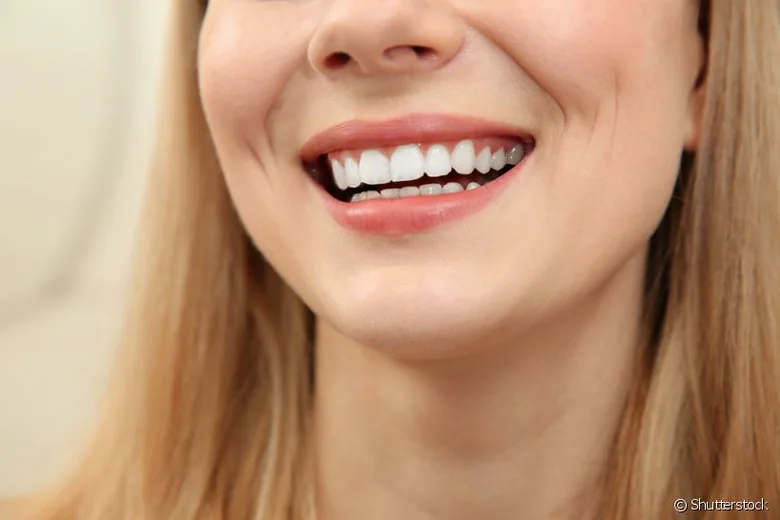 Sorriso com dentes claros após clareamento dental