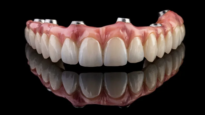 Modelo de arcada com protocolo fixo sobre implantes