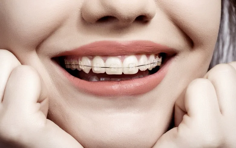 Sorriso com aparelho ortodôntico estético de bráquetes claros